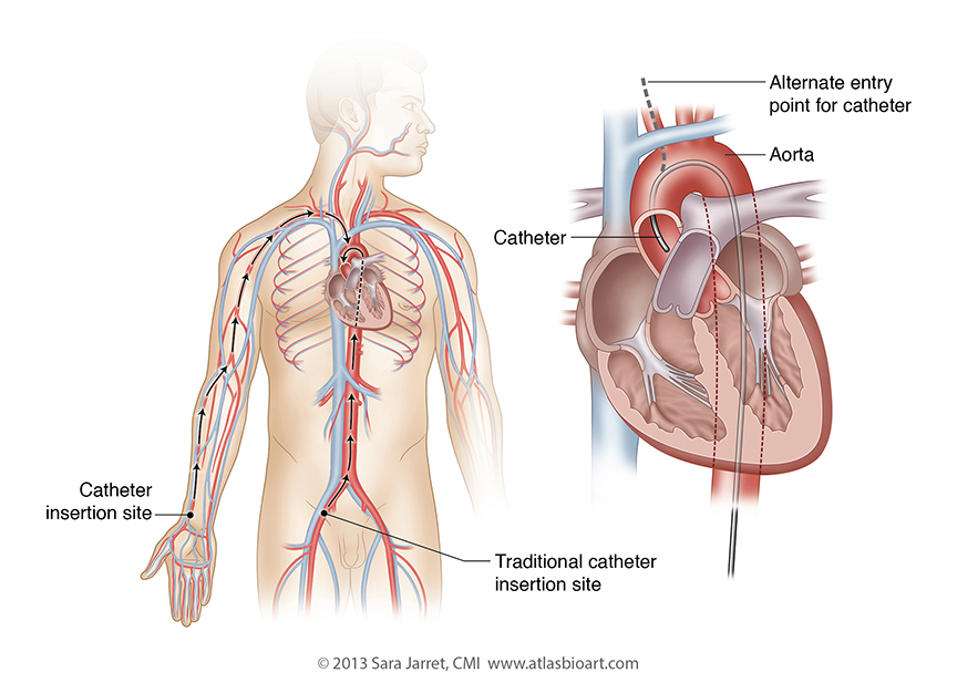 Cardiac Cath for HCM